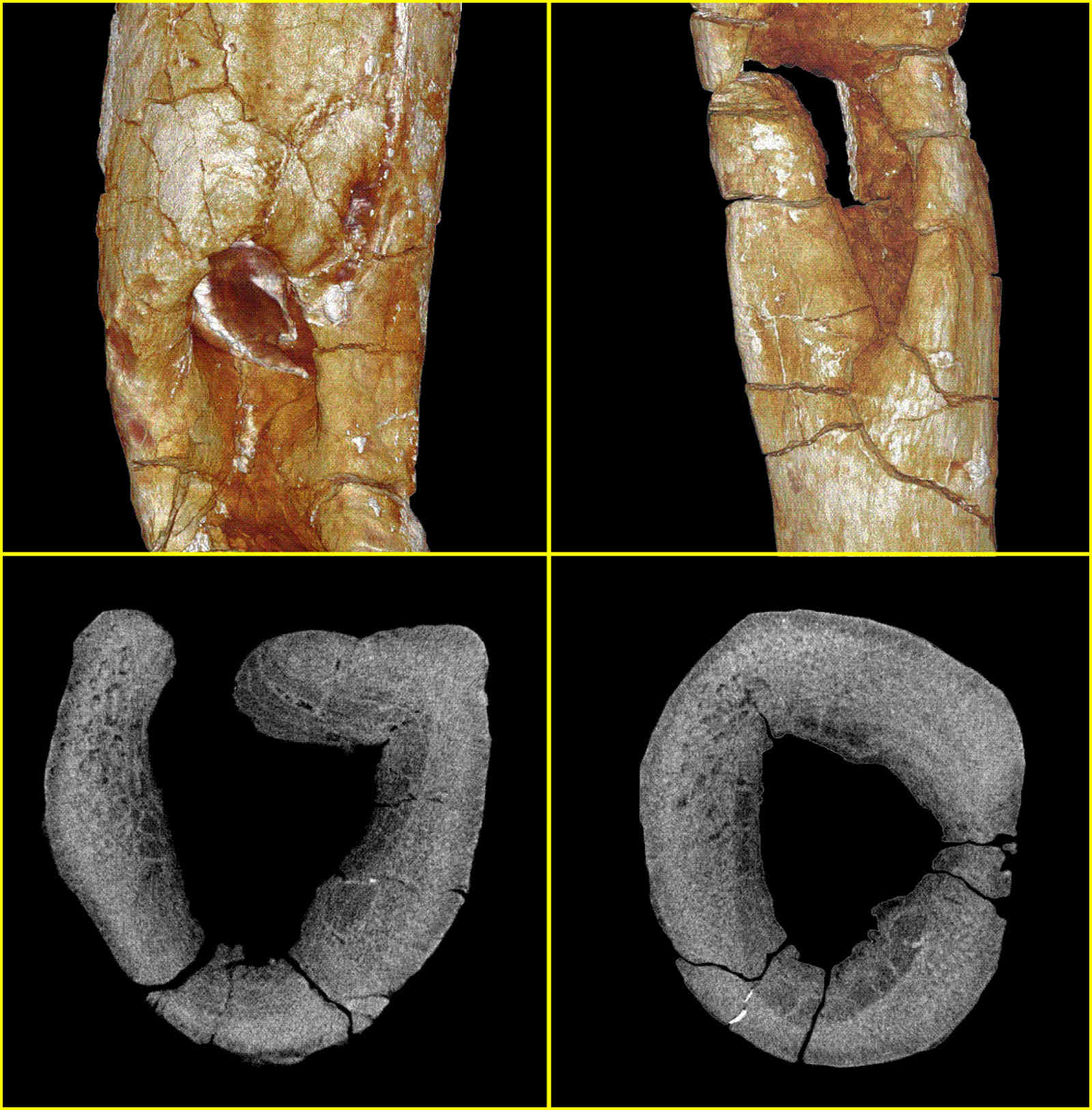 肋骨病灶的CT图像（制图 邢立达）.jpg