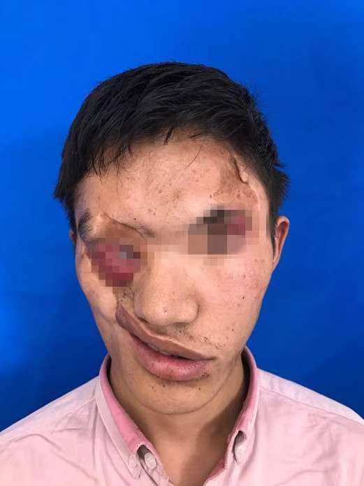 西藏一小伙幼时感染"走马疳"面部严重畸形,上海这家医院成功救了他的"