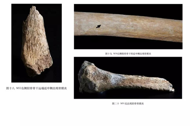 咸阳渭城区秦墓？人骨病例分析。.jpg