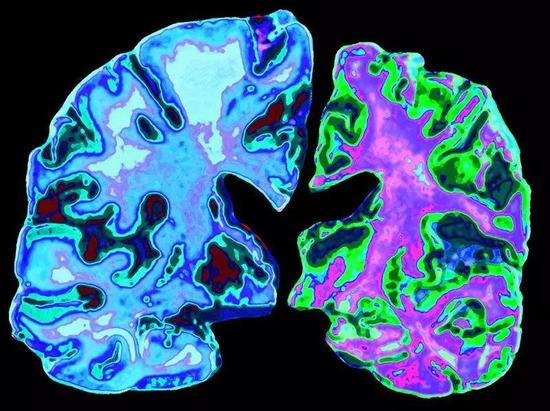 图|与70岁的正常大脑（左）相比，70岁阿尔茨海默病患者的大脑切片（图片来源：JessicaWilson/SciencePhotoLibrary）