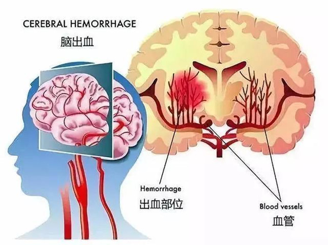 頭暈常與頭痛伴發,特別是在小腦和腦幹出血時,還會伴有噁心,嘔吐等