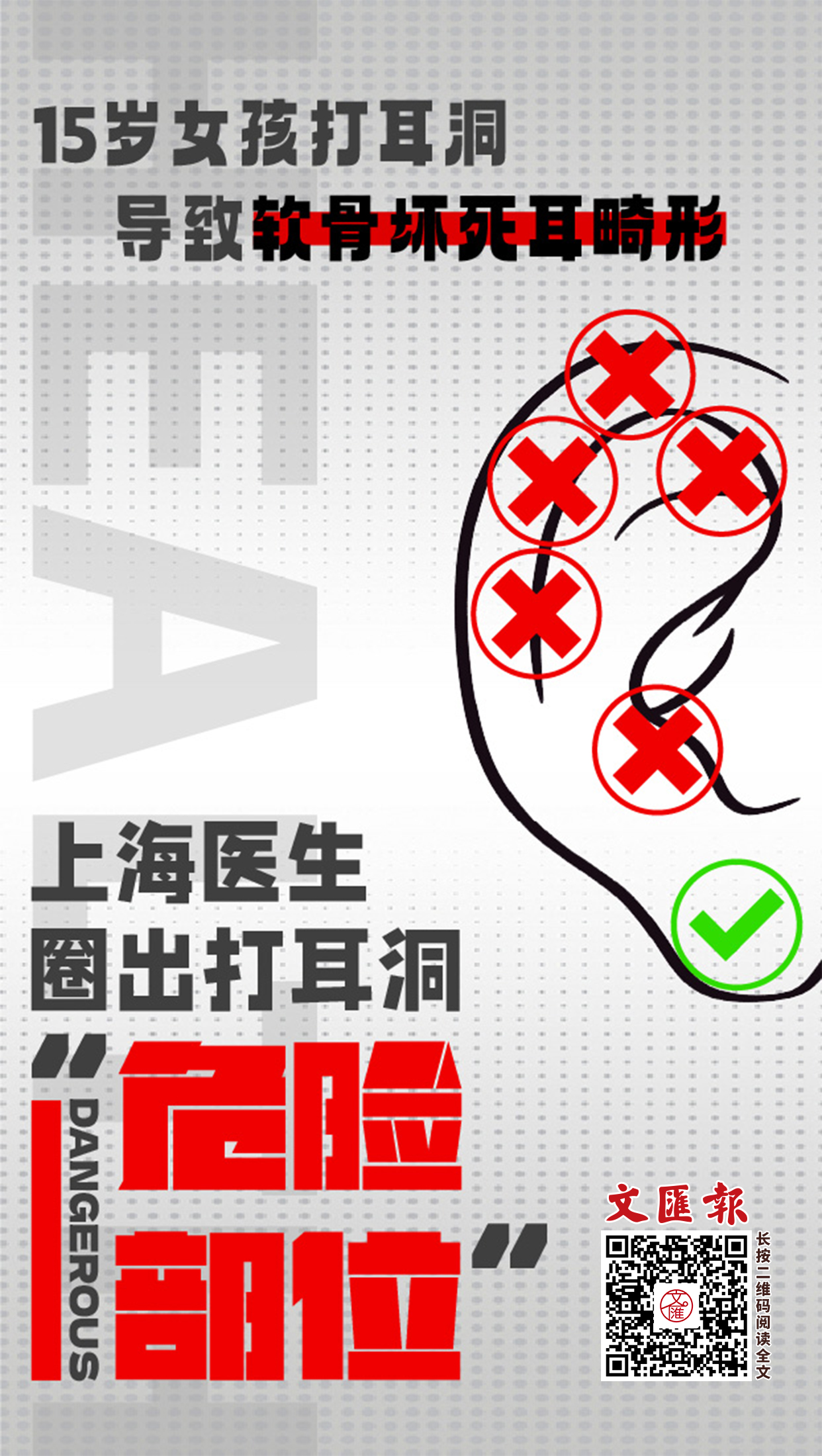 15岁女孩打耳洞导致软骨坏死耳畸形,上海医生圈出打耳洞“危险部位”.jpg 15岁女孩打耳洞导致软骨坏死耳畸形,上海医生圈出打耳洞“危险部位”.jpg
